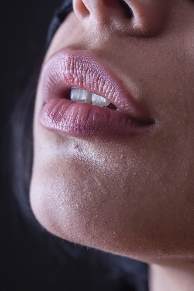 filler per le labbra